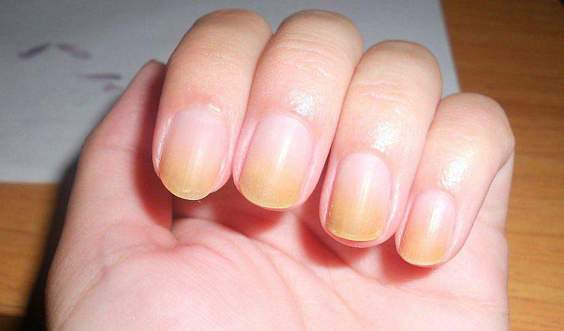 ¡Qué lindo! 5 remedios caseros para eliminar las uñas amarillas
