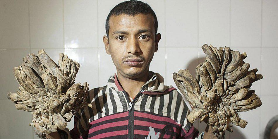 ​"Hombre árbol" está dos años atrapado en un hospital sin hallar cura