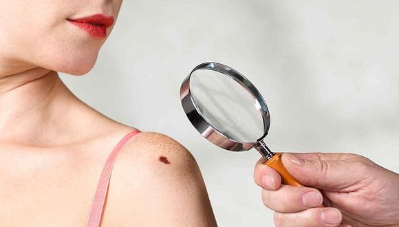 ¿Cómo protegerse para evitar el cáncer a la piel? 
