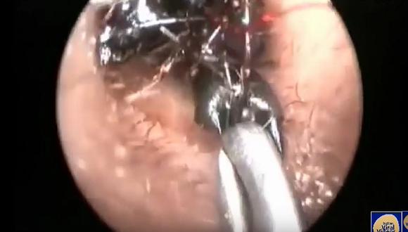 ​Youtube: Así sacaron miles de hormigas dentro del oído de una niña 