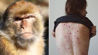 Viruela del mono: ¿Qué hago si tengo los síntomas?