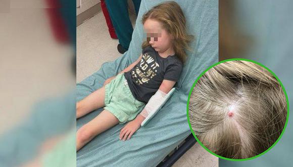 Niña de cinco años sufre parálisis repentina tras picadura de insecto (FOTOS)
