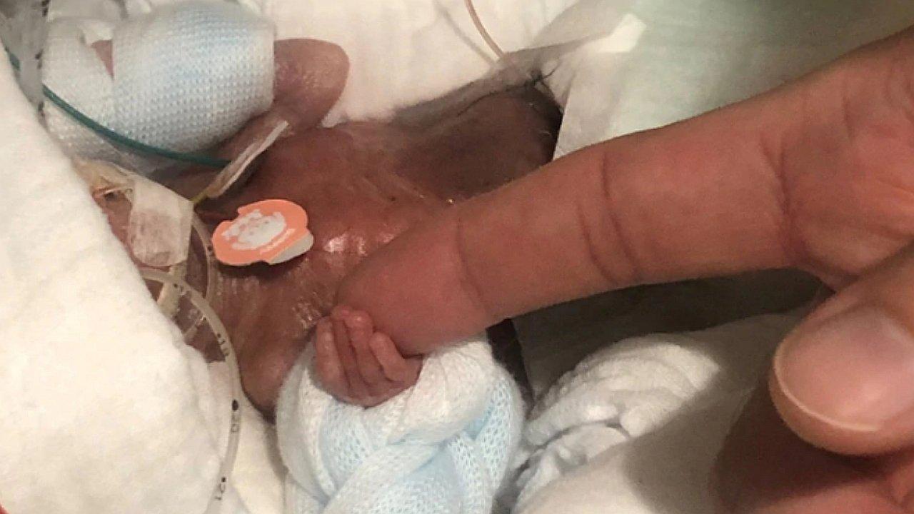 Dan de alta al bebé más pequeño del mundo: nació con 268 gramos (FOTOS)