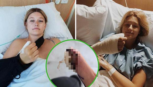 Mujer desarrolla cáncer por sufrir bullying y morderse las uñas (FOTOS)