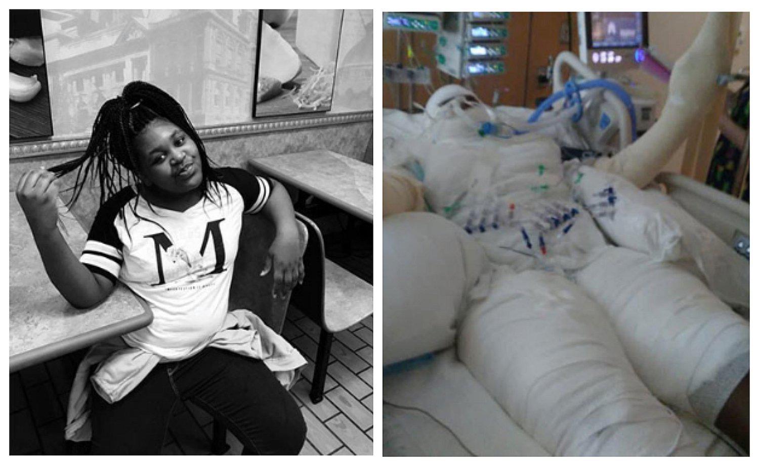 Adolescente casi muere tras prenderse fuego por desafío viral (FOTO)