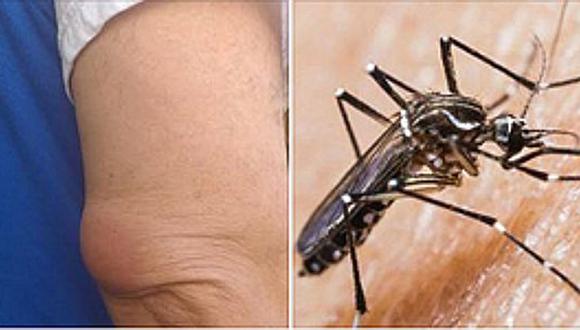 Callao: doctor fue a atender a paciente y sufrió picadura de mosquito aedes aegypti