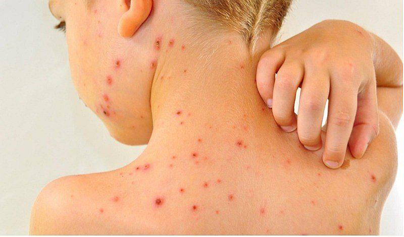 3 diferencias entre la Varicela y el Sarampión