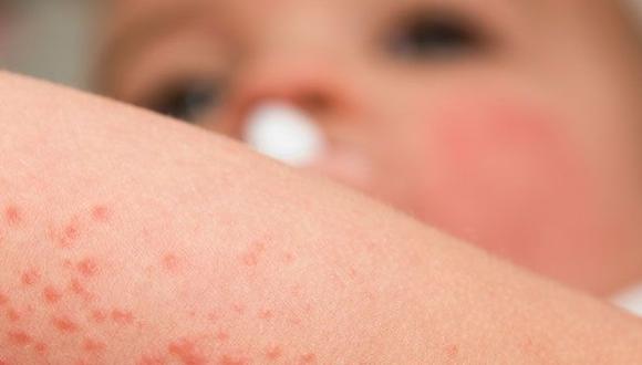 La dermatóloga señala que la mayoría de los sarpullidos ocurren cuando la piel entra en contacto con una sustancia que la irrita. Esto se conoce como dermatitis de contacto. (Foto: Difusión)