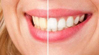 TIPS ¿Cómo blanquear los dientes de forma natural?
