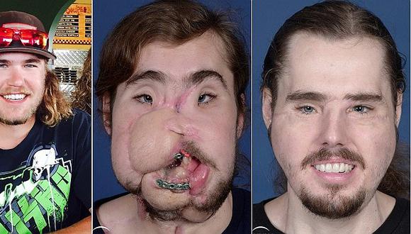 Extraordinaria cirugía en el rostro devuelve la felicidad a un soldador (FOTOS)