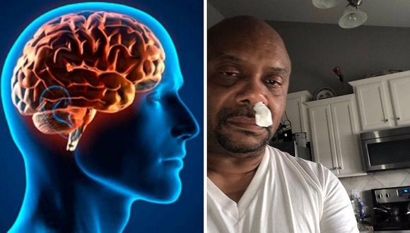 Hombre pensaba que tenía sinusitis, pero descubre terrible fuga de líquido cerebral