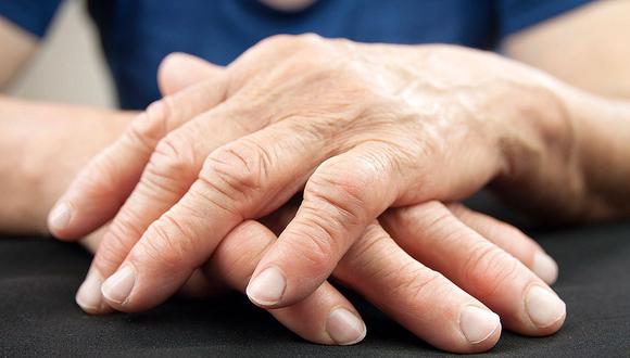 Artritis: diagnóstico temprano y tratamiento son claves para frenar efectos
