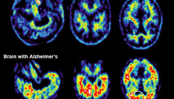 La resistencia del cerebro al estrés previene el alzheimer 