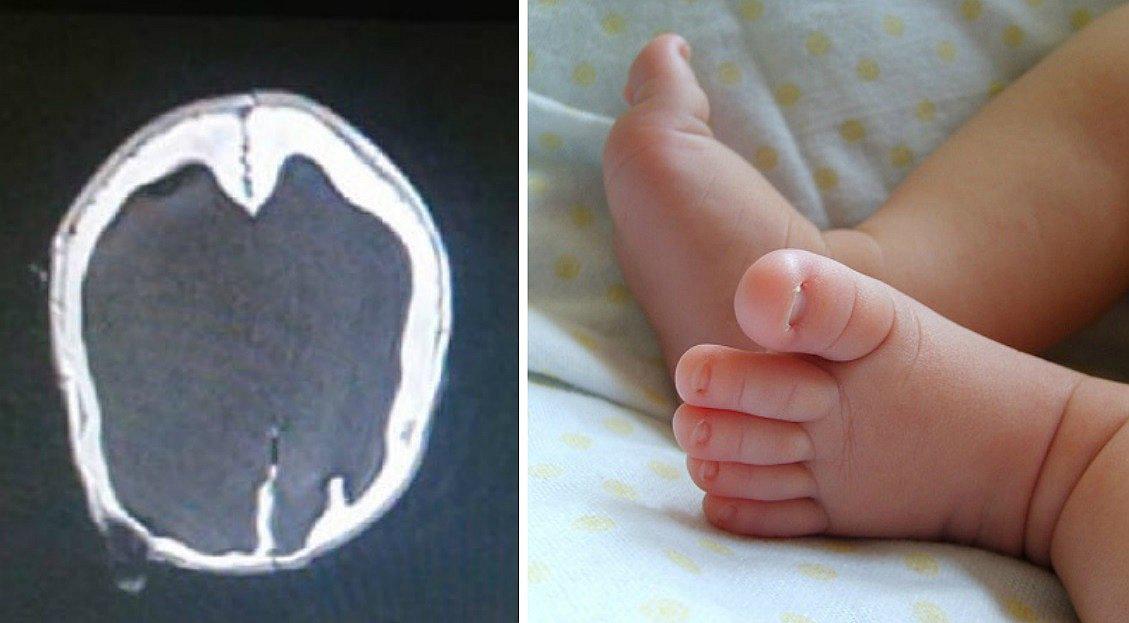 Nació bebé sin cerebro, sobrevivió pero años después médicos se sorprenden al hallar esto