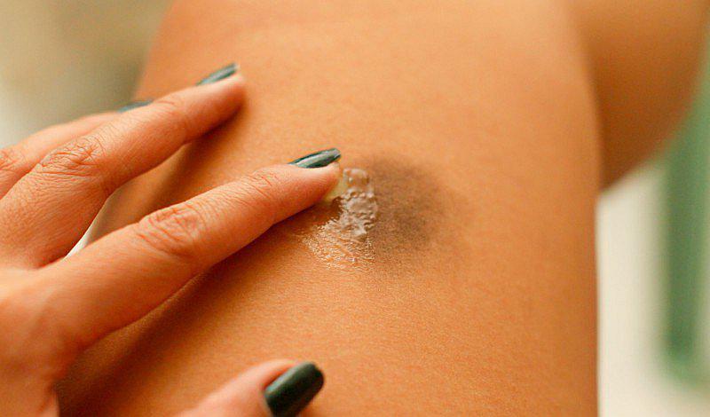 Estos son los 5 remedios sencillos para aliviar los moretones 