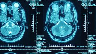 Con imágenes se puede predecir el alzhéimer con 15 años de antelación 
