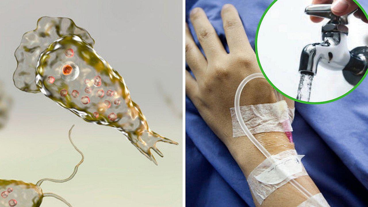 Mujer muere por ameba come cerebros que contrajo cuando se lavaba la nariz 