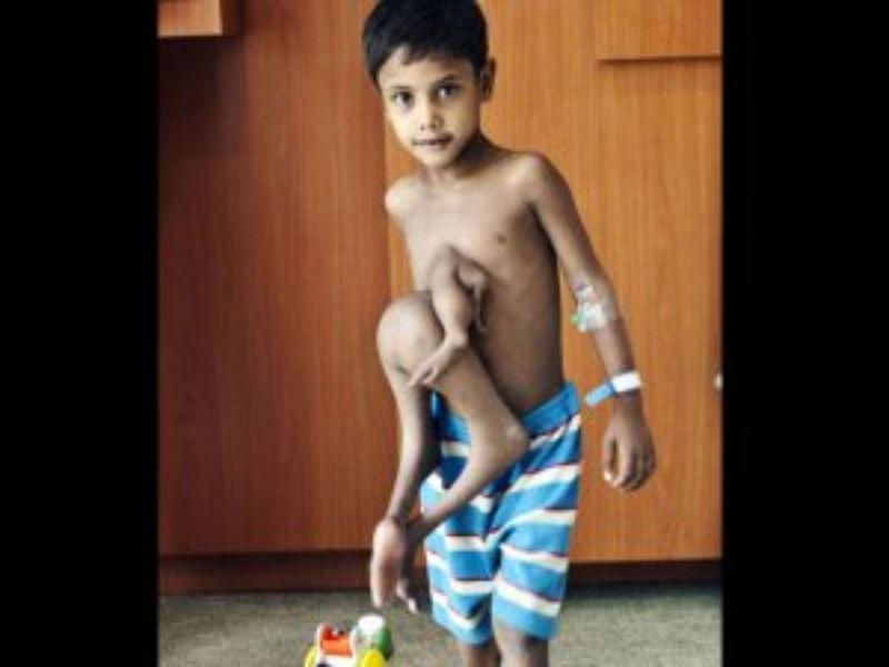 En la India un niño vivió 6 años con su gemelo atravesado 