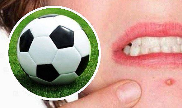 ​Extraen un 'grano' gigante del tamaño de una pelota de fútbol (VIDEO)