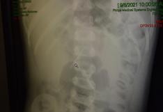 INSN de Breña: médicos operan con éxito a niño de 2 años que tenía una aguja incrustada en el intestino