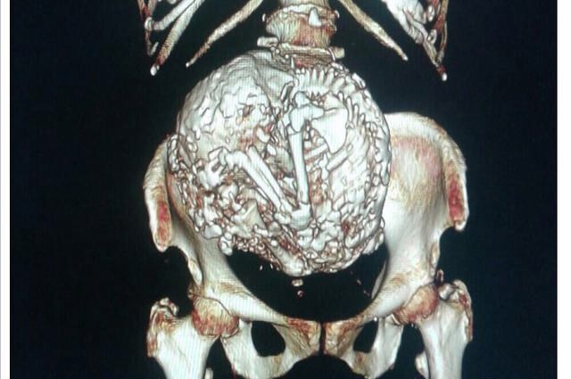 Chile: Anciana de 92 años lleva un feto momificado desde hace medio siglo [FOTO]