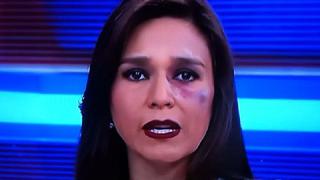 ​Verónica Linares aparece en vivo con moretón en el rostro ¿Qué pasó? [VIDEO]