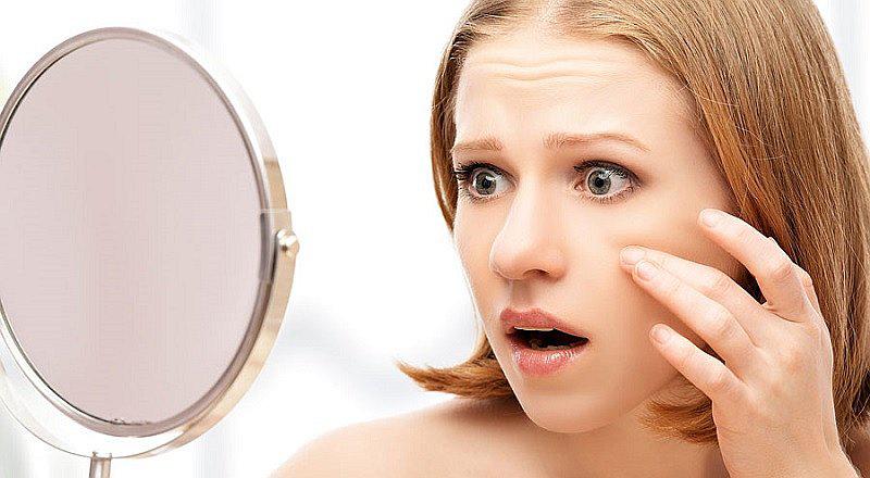 ¿Cómo combatir el acné? Cinco tratamientos que te pueden ayudar