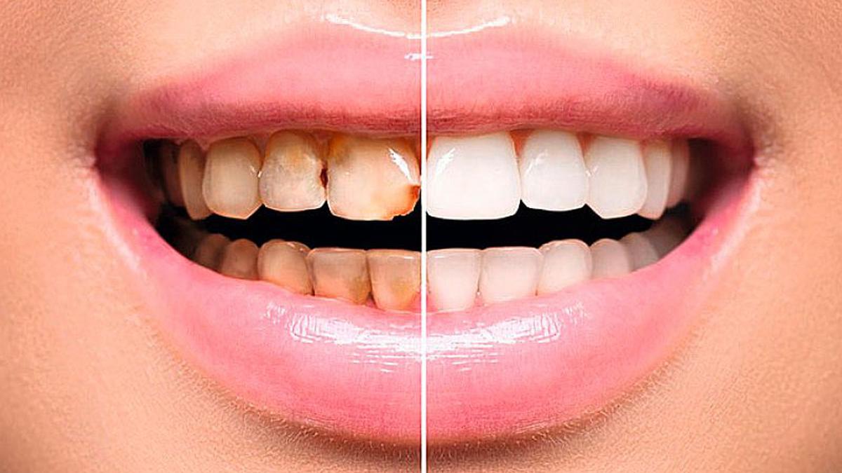 Dientes Perfectos Como Los Famosos Todo Sobre Las Carillas Dentales Mujer Ojo