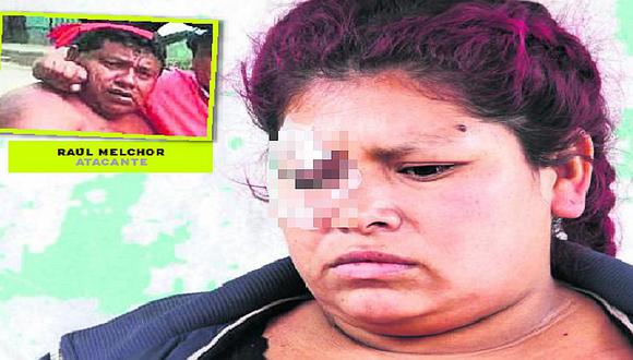 Mujer pierde el ojo derecho tras ataque de su expareja con destornillador