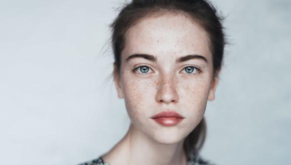 “Las pecas son acumulaciones de pigmento que aparecen en todo el rostro, pero sobre todo en aquellas zonas más expuestas al sol: las mejillas y la nariz", dice especialista. (Foto: Shutterstock)