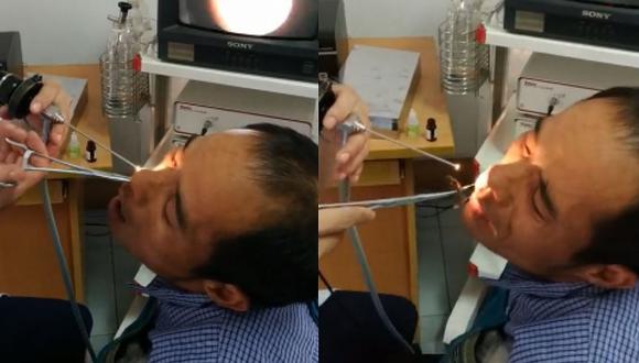 Hombre se quejaba por fuerte dolor en la nariz y le encuentran un curioso animal (VIDEO)