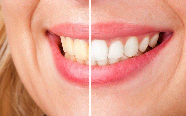 TIPS ¿Cómo blanquear los dientes de forma natural?