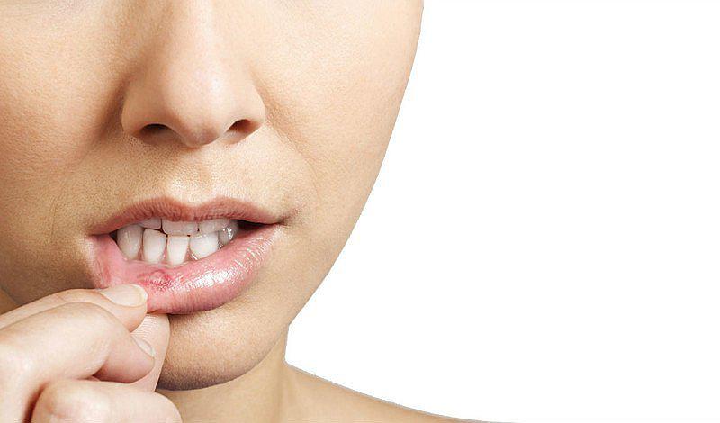 ¿Qué son los aftas? Conoce sus causas y cómo prevenirlo