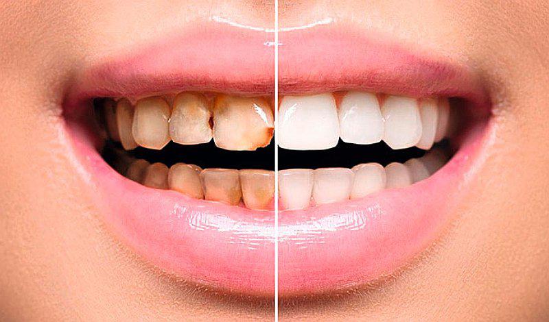 Luce dientes perfectos como los famosos con las carillas dentales