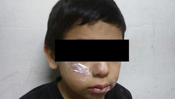 Chiclayo: Madre quema rostro de su hijito de 5 años y huye de posta médica
