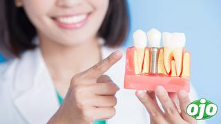 Implantes dentales: Aspectos a considerar para elegir uno bueno 