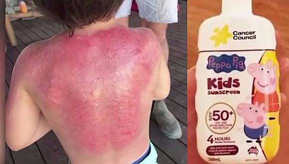 Protector solar de Peppa Pig le ocasionó graves quemaduras a niño (VIDEO) 