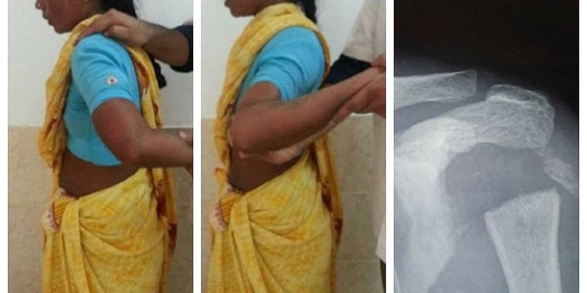 Extraña enfermedad permite a mujer girar el hombro en 180 grados 