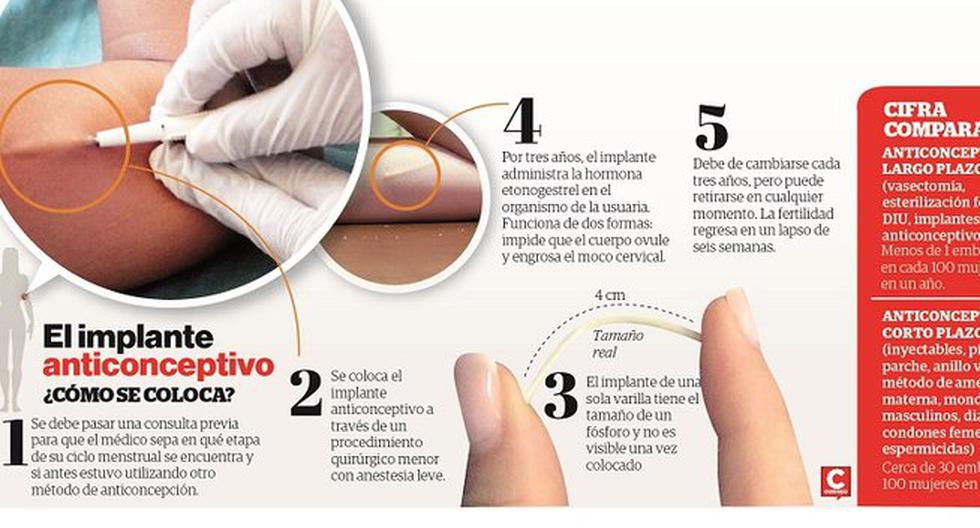 Implante anticonceptivo: Una medida efectiva y accesible | CIUDAD | OJO