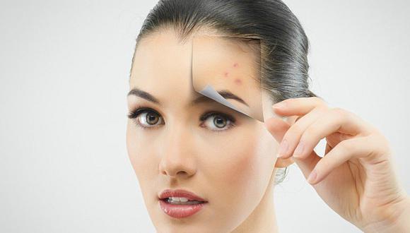 Conoce las 6 zonas más frecuentes del acné