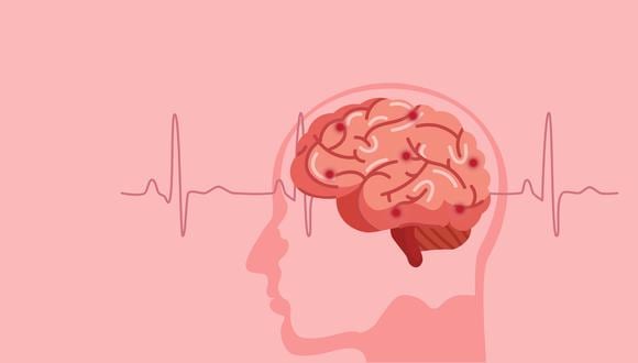 “Existen dos tipos de accidentes cerebrovasculares: los isquémicos,  y los hemorrágicos” explica la neuróloga, María Teresa Reyes. (Foto: Shutterstock)