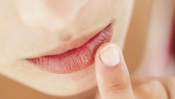 ¡Mejora tu salud! 6 remedios caseros para tratar el herpes labial