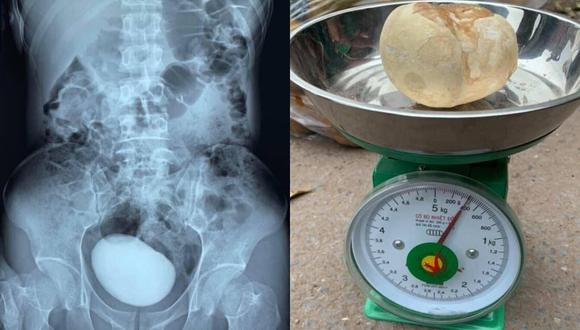 Tras someterse a una tomografía, los médicos detectaron que la mujer tenía un enorme cálculo en su vejiga. | Foto: Facebook/VI VU Thái Nguyên