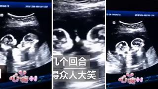 YouTube: ecografía capta "pelea" entre gemelas en el vientre de su mamá (VIDEO)