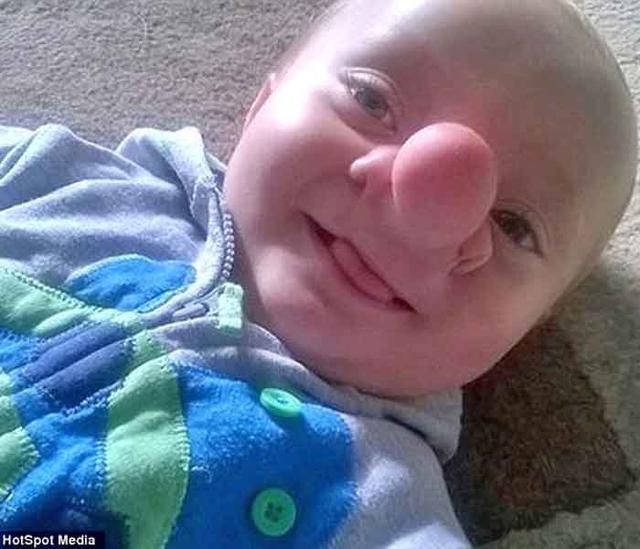 ​Esta es la conmovedora historia del "pinocho de la vida real" [FOTOS]