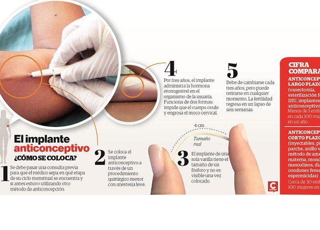 Implante anticonceptivo: Una medida efectiva y accesible