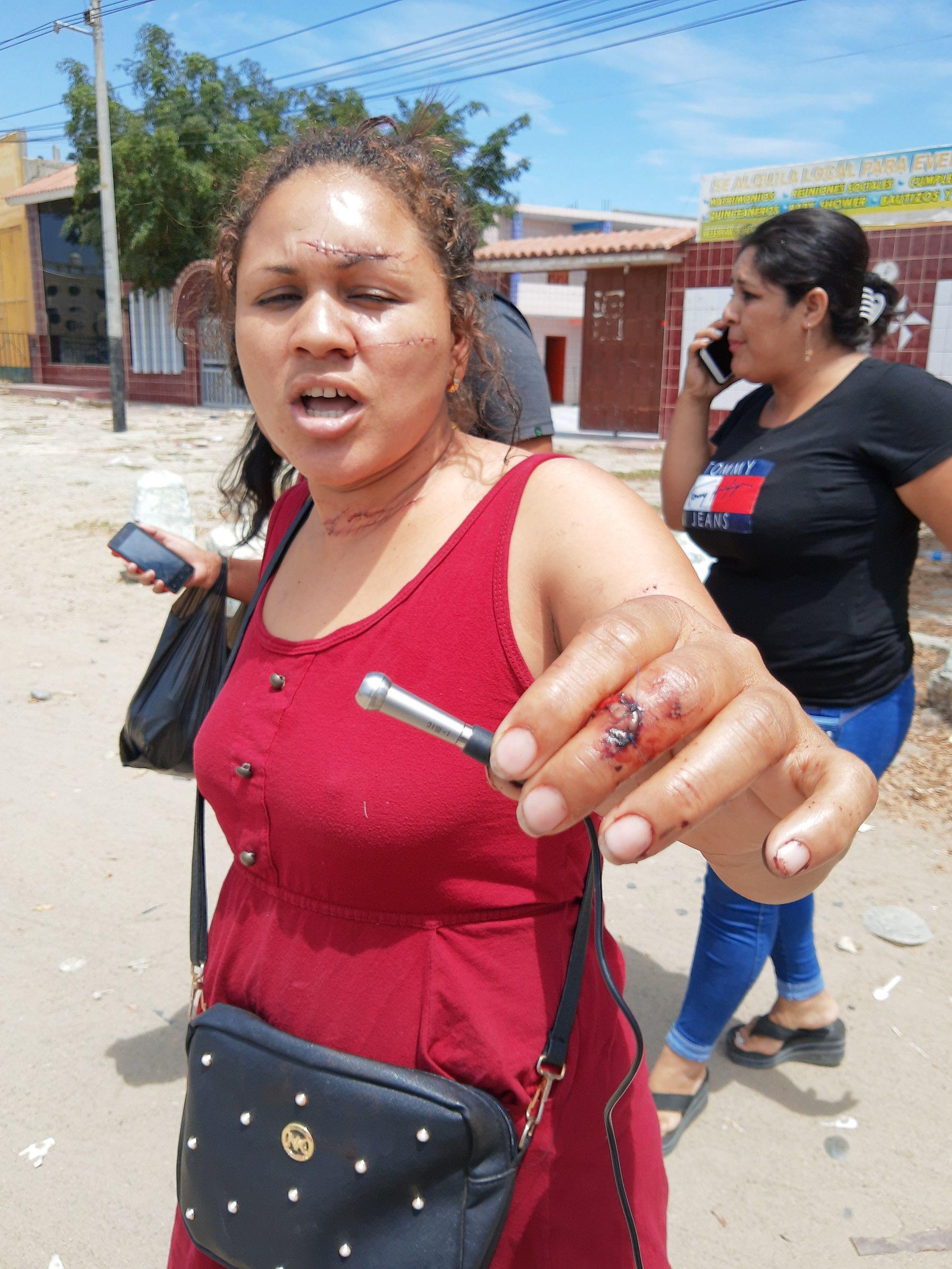 Piura. Los médicos le suturaron 50 puntos a Nefri Ríos. (GEC)