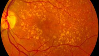 Identifican 52 variaciones genéticas que hacen perder la vista
