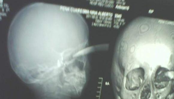 Niño sobrevive tras incrustarse accidentalmente una hoz en la cabeza 