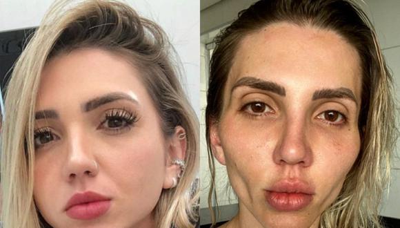 Una influencer brasileña se arrepiente de cirugía que se hizo en el rostro. (Foto: @eusoufrozza / Instagram)